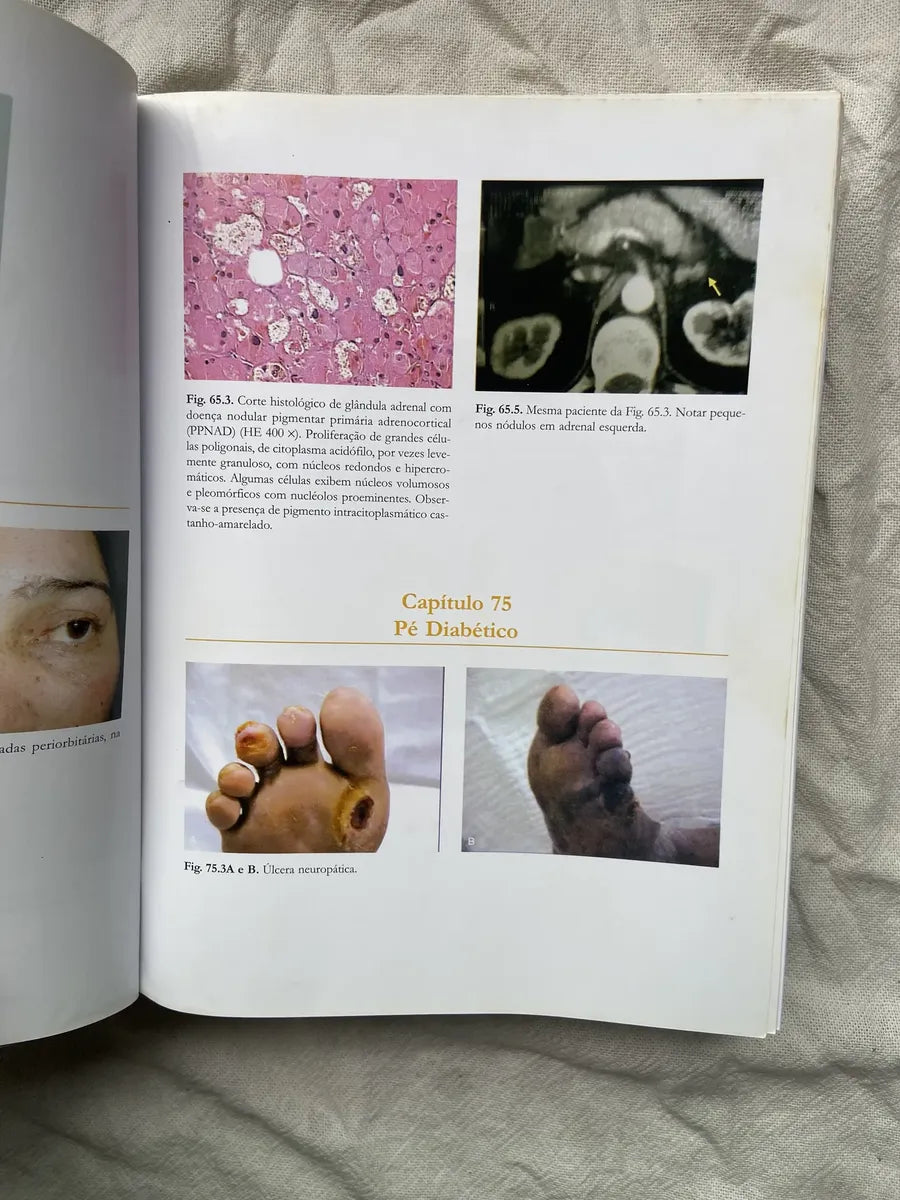 Livro Endocrinologia E Diabetes 2003 (Usado)