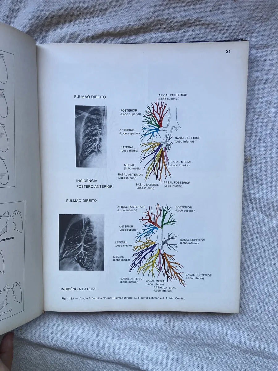 Livro Radiologia Pulmonar 1984 Capa Dura (Usado)